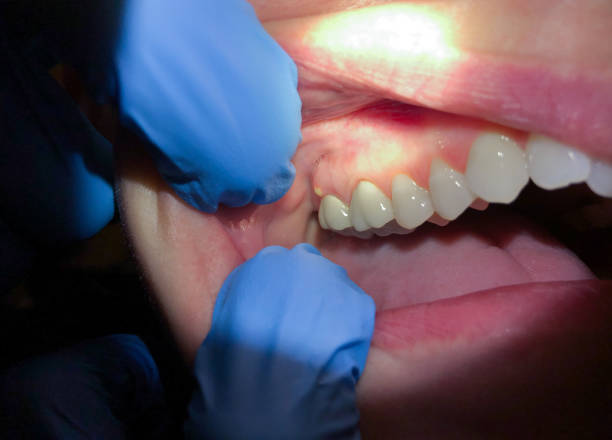 Best Emergency Broken Tooth Repair in Battle Creek, MI